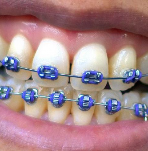 5 Reasons Why You Should Avoid DIY Braces - The Sideline View